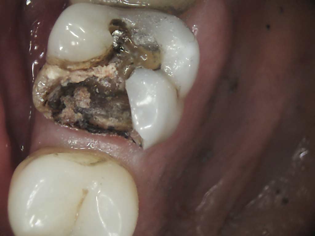 Worn and amalgam filling removed and decay under filling exposed
